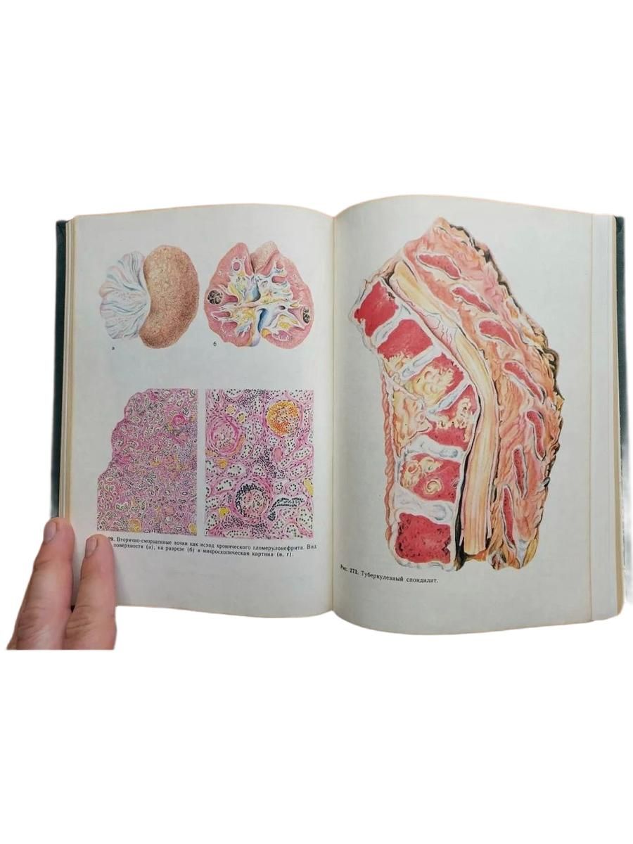 Патологическая анатомия. Учебник. 1993г. — изображение 3